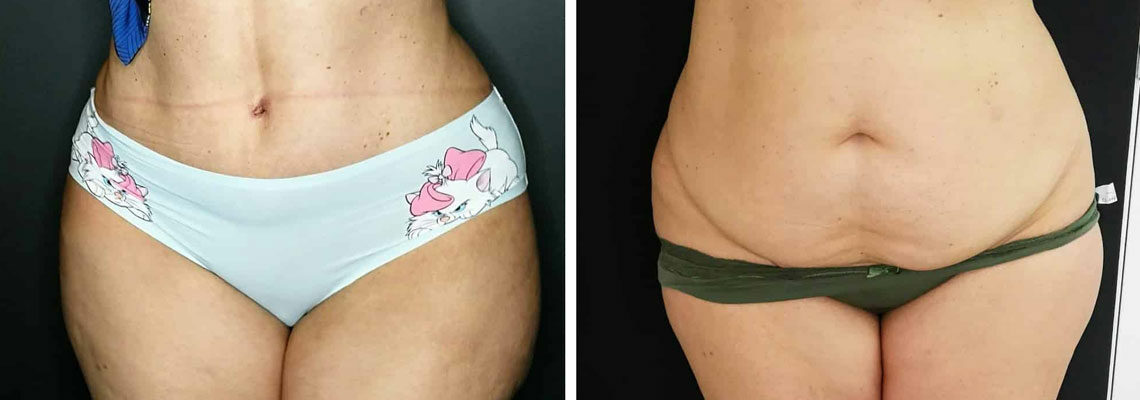 abdominoplastie